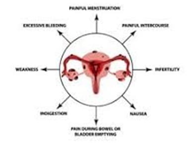 Endometriosis