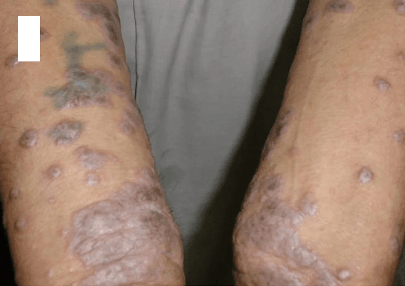 Lichen Planus in Ayurveda: Understanding and Managing the Condition Naturally